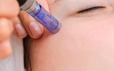 Transforma tu Piel con Dermapen y Exosomas: Innovación y Elegancia en Kursaal Aesthetics