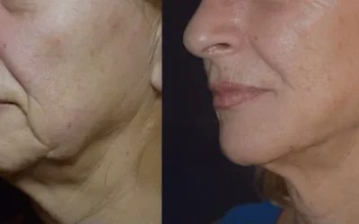 Transformación Elegante: FaceTite y Morpheus8 en Kursaal Aesthetics