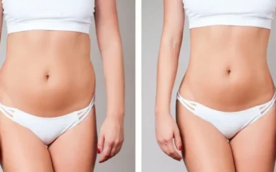Coolsculpting: Innovación en la Eliminación de Grasa en Málaga y Alhaurín de la Torre