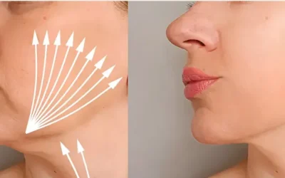 Morpheus 8: Belleza redefinida con precisión desde Burjassot a la clínica más avanzada